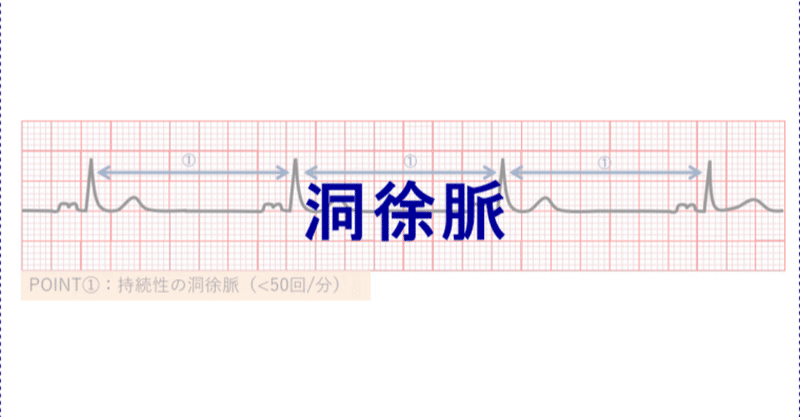 心電図イラスト 洞徐脈 Ceme Jpeg Note