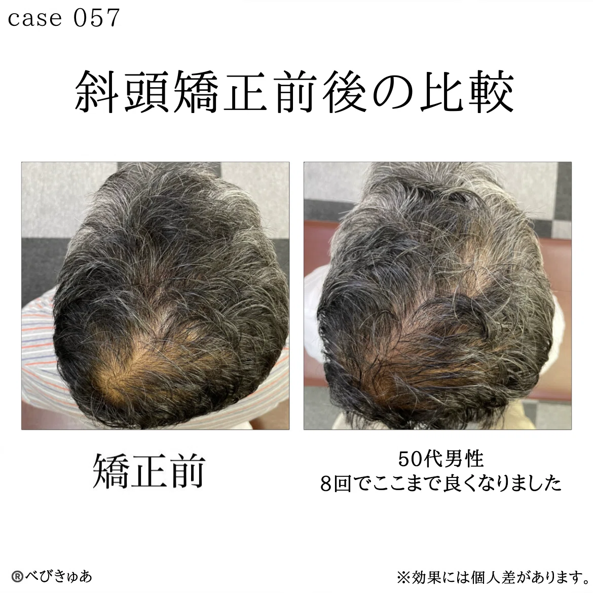 斜 頭 症 大人
