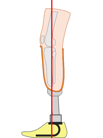 下腿義足 異常アライメント 膝折れ編｜じょんがらPT