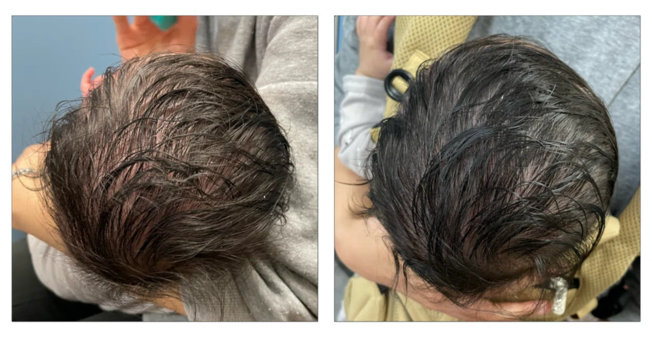 Treatment Example: Severe Brachycephaly and Right Plagiocephaly｜山田光敏