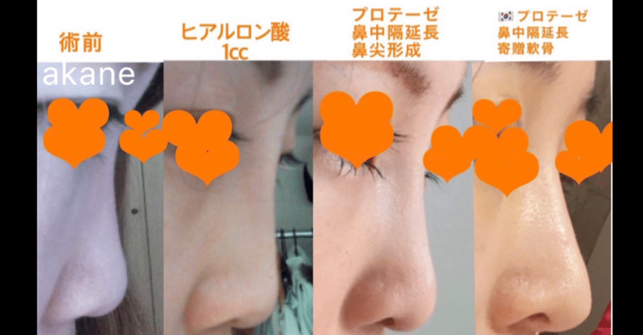 鼻整形の話 Akane Note