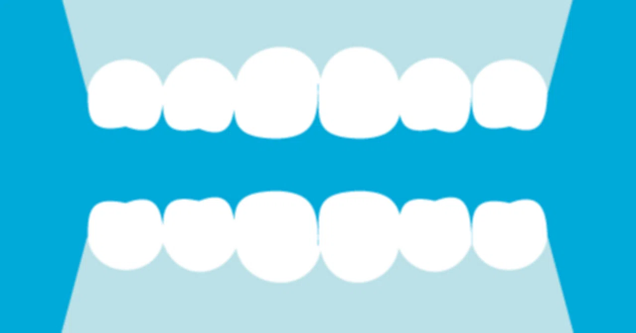 Invisalign Orthodontics | 6 Things I Was Glad I Had Prepared｜ととまる