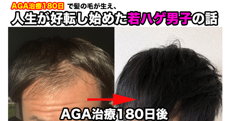 Aga治療180日で髪の毛が生え 人生が好転し始めた若ハゲ男子の話 ルフ Aga治療中 Note