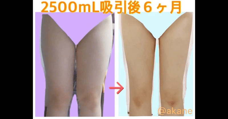 太もも 臀部 脂肪吸引の話 Akane Note