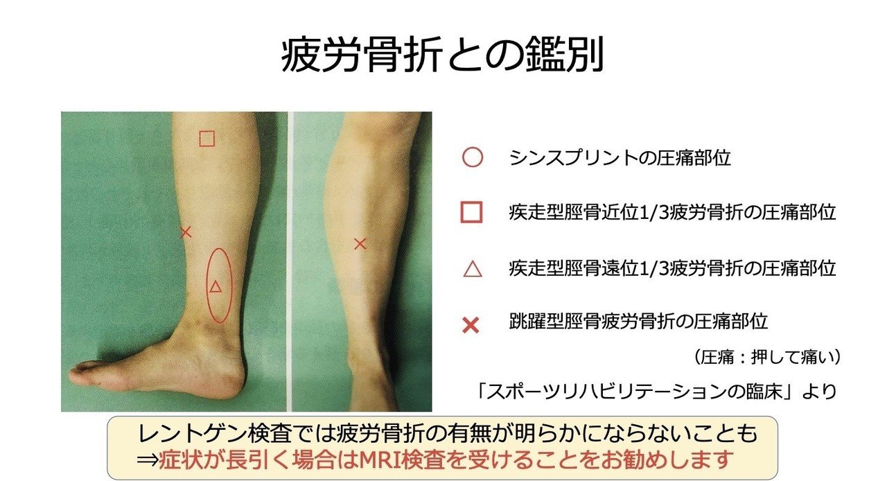 シンスプリントの治療 予防戦略 Naoyuki Jin Note シンスプリントの治療 予防戦略 Naoyuki Jin Note