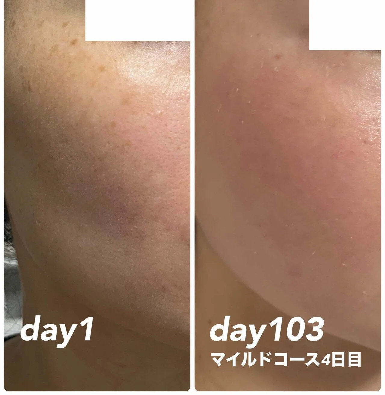 専用ページ　ゼオスキン　4点 4ヶ月目】ゼオスキンで肌革命｜ぽめら