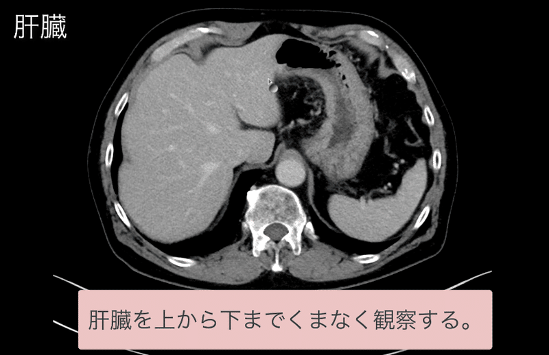 見逃しを防ぐための腹部ctの読影の順番 ごろ にゃ 放射線科医 画像診断医 Note 見逃しを防ぐための腹部ctの読影の順番 ごろ にゃ 放射線科医 画像診断医 Note