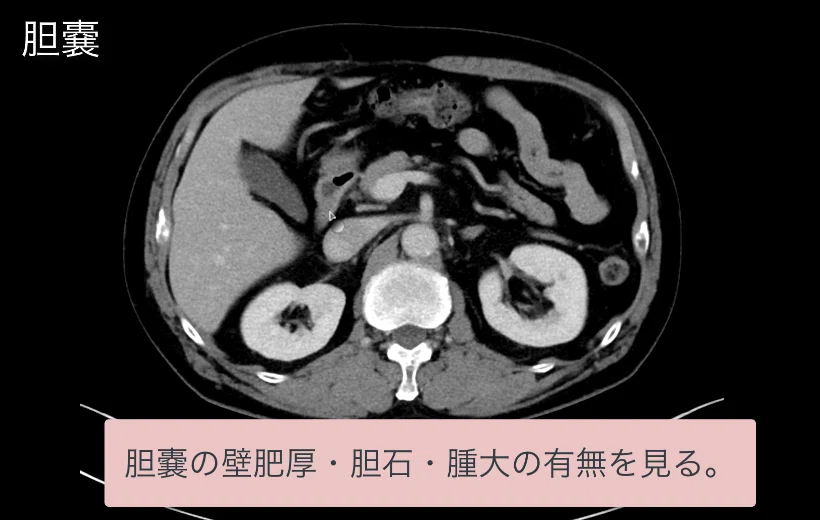 見逃しを防ぐための腹部CTの読影の順番｜ごろ〜にゃ@放射線科医の
