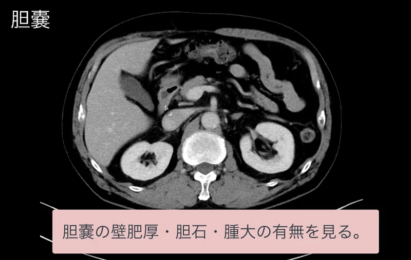 見逃しを防ぐための腹部ctの読影の順番 ごろ にゃ 放射線科医 画像診断医 Note