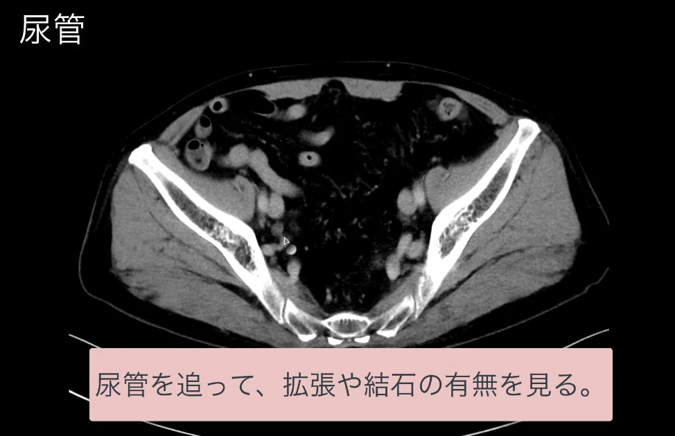 見逃しを防ぐための腹部CTの読影の順番｜ごろ〜にゃ@放射線科医の