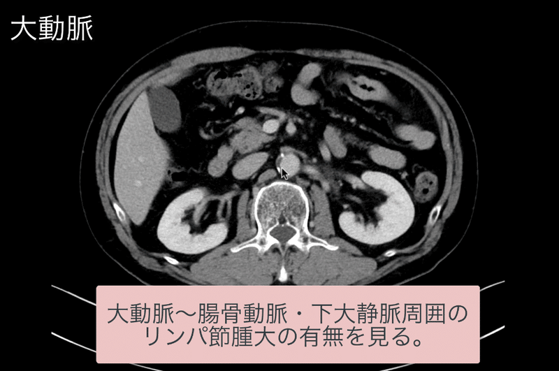 見逃しを防ぐための腹部ctの読影の順番 ごろ にゃ 放射線科医 画像診断医 Note 見逃しを防ぐための腹部ctの読影の順番 ごろ にゃ 放射線科医 画像診断医 Note