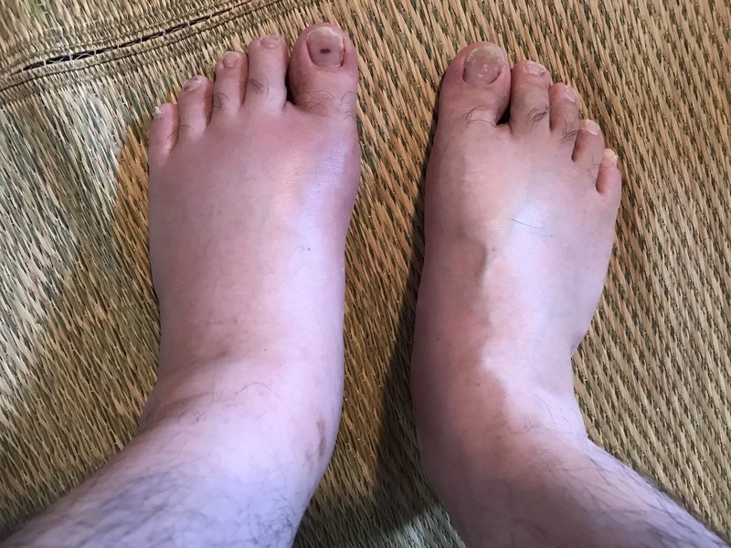 痛風改善のために尿療法を試していきます ロケットスター Note