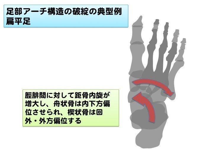 扁平足