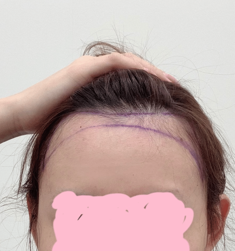 小顔にしたい方必見 韓国で話題のヘアライン矯正 アルタス植毛レポ Ame Note 小顔にしたい方必見 韓国で話題のヘアライン矯正 アルタス植毛レポ Ame Note