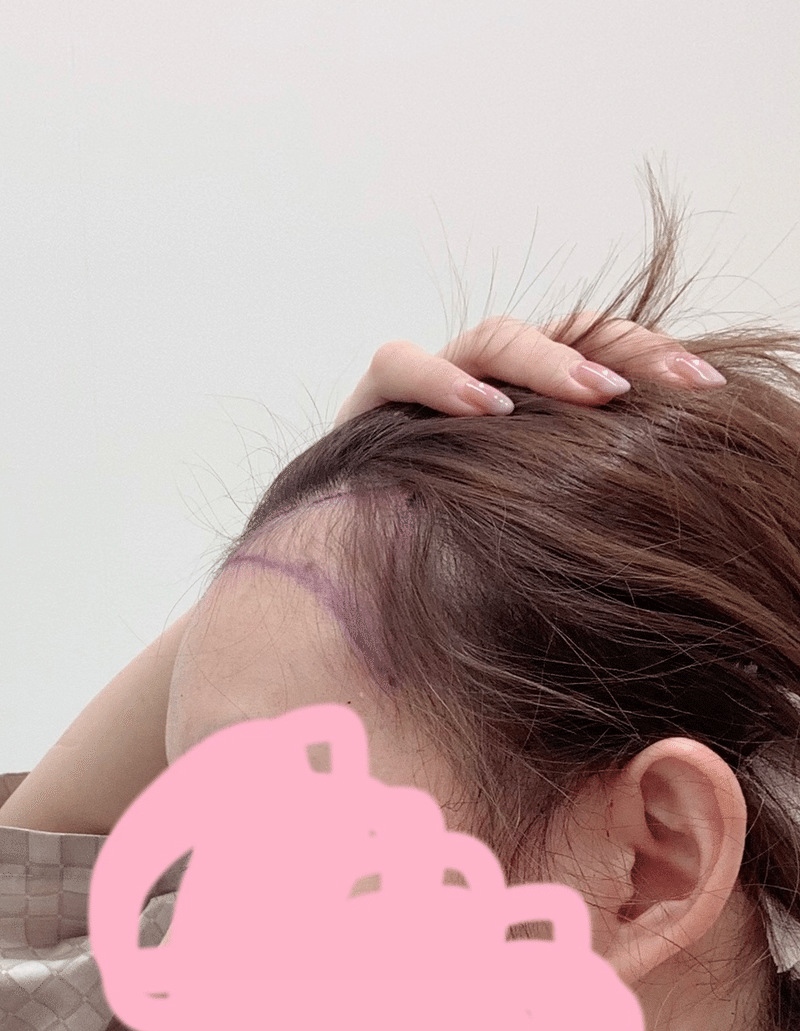 小顔にしたい方必見 韓国で話題のヘアライン矯正 アルタス植毛レポ Ame Note 小顔にしたい方必見 韓国で話題のヘアライン矯正 アルタス植毛レポ Ame Note