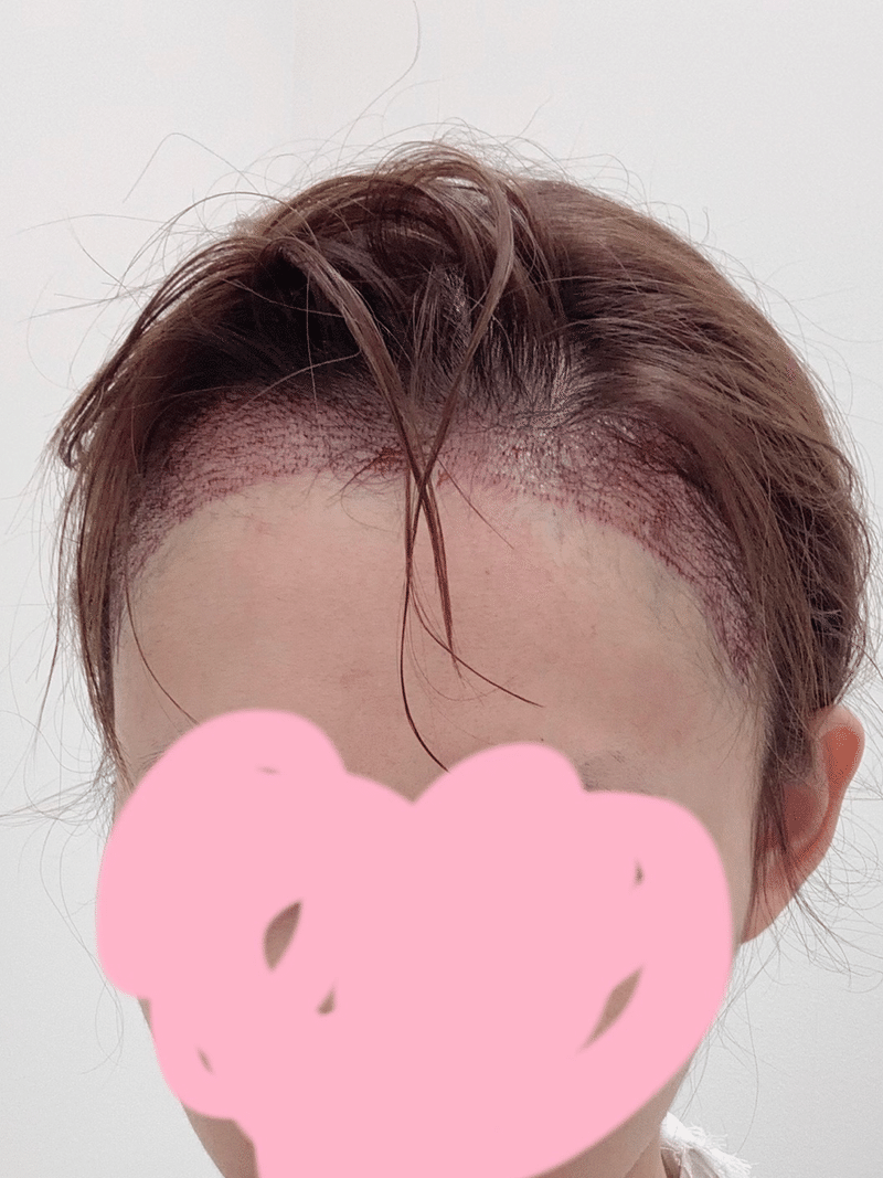 小顔にしたい方必見 韓国で話題のヘアライン矯正 アルタス植毛レポ Ame Note 小顔にしたい方必見 韓国で話題のヘアライン矯正 アルタス植毛レポ Ame Note