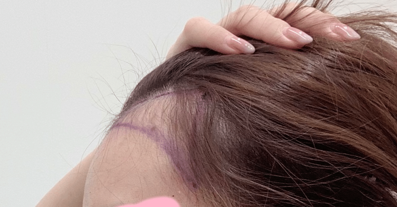 ロッジ 決めます 費用 ヘアライン 矯正 韓国 Npower Jp ロッジ 決めます 費用 ヘアライン 矯正 韓国 Npower Jp