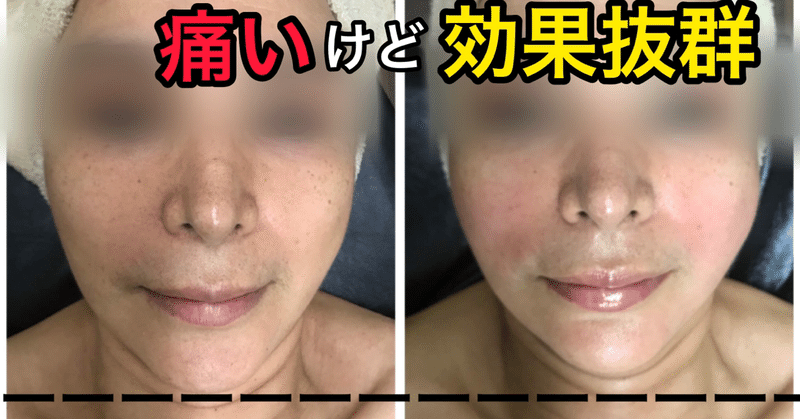 小顔コルギ エーアイ ルミナス Note