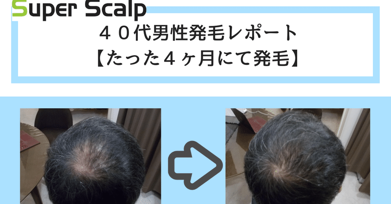 ４０代男の薄毛・AGAは正しく薄毛治療を【実データあり】