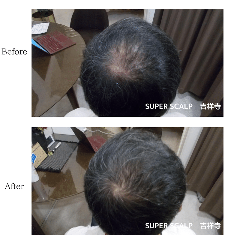 40代男の薄毛 Agaは正しく薄毛治療を 実データあり りょーすけ先生 髪ワザchannel Note 40代男の薄毛 Agaは正しく薄毛治療を 実データあり りょーすけ先生 髪ワザchannel Note