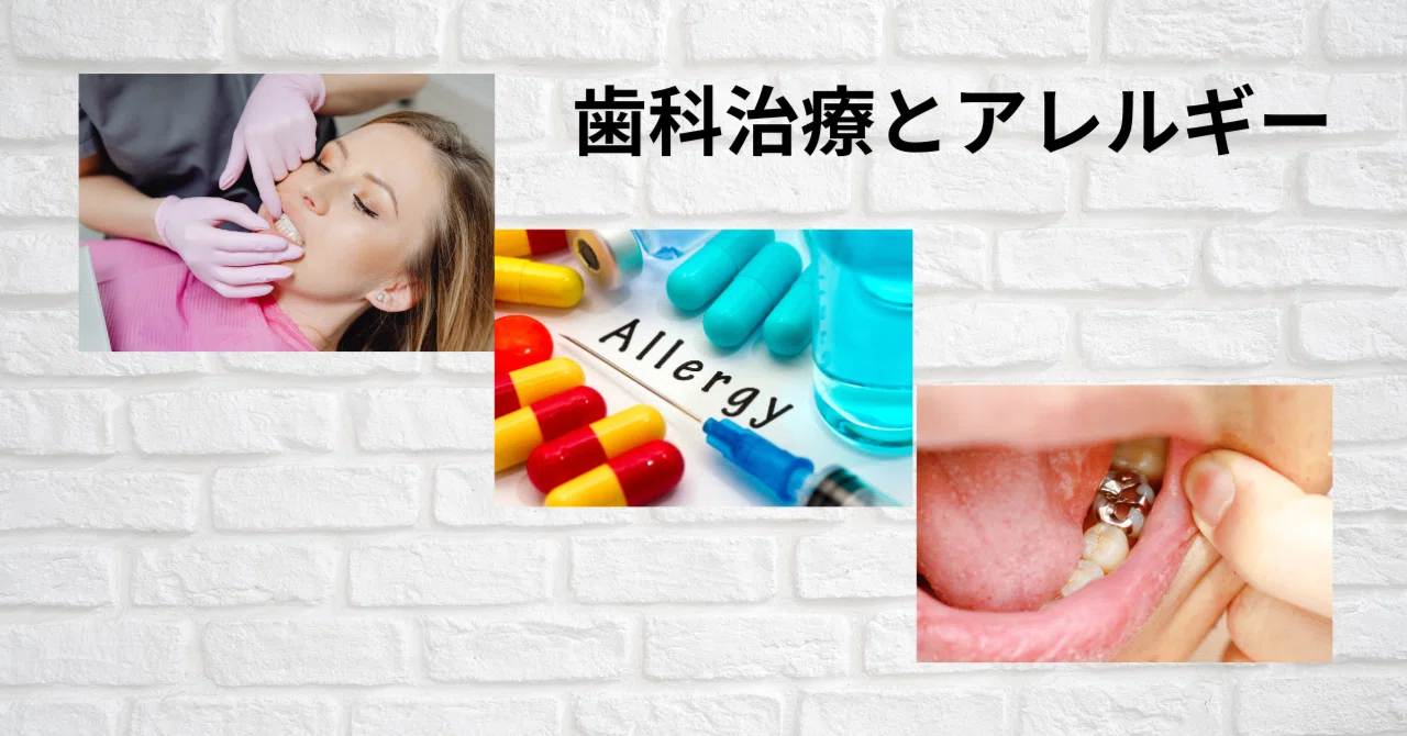 歯科治療とアレルギー｜いずみ中山歯科