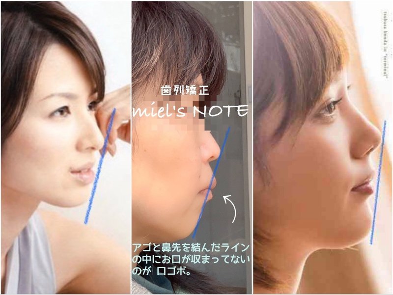 出っ歯 口ゴボ 青ゴム Miel Note 出っ歯 口ゴボ 青ゴム Miel Note
