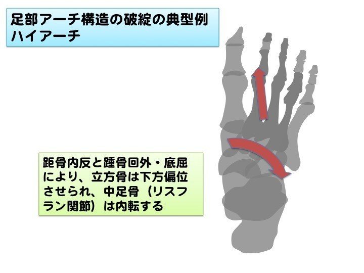 典型例（ハイアーチ）