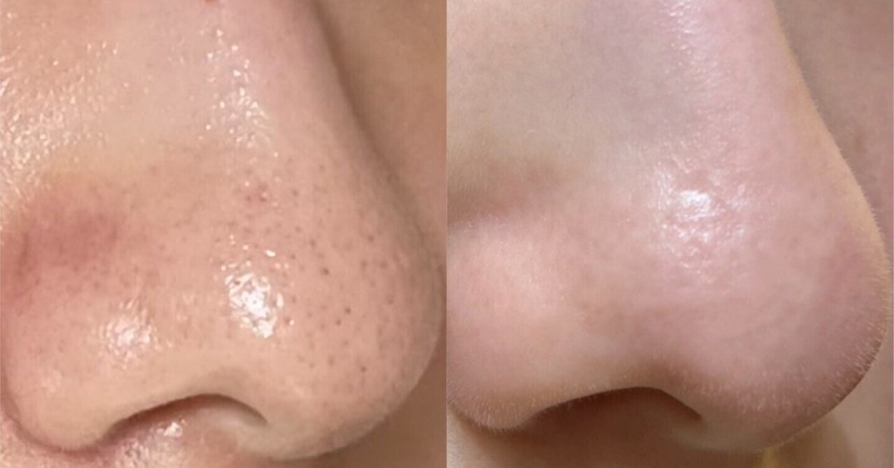 肌改善②毛穴との闘いの成果 前編｜Rinnna