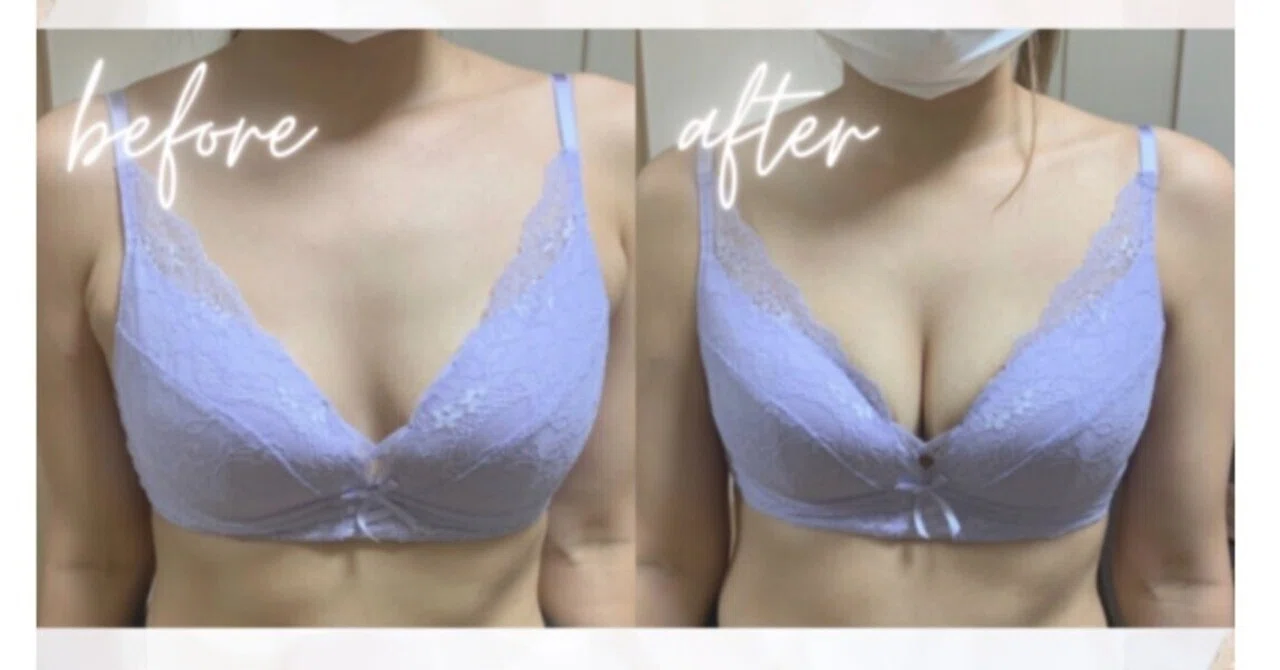 痛くない・切らない】バストアップ美乳鍼とは？施術効果や胸に鍼をうつ 