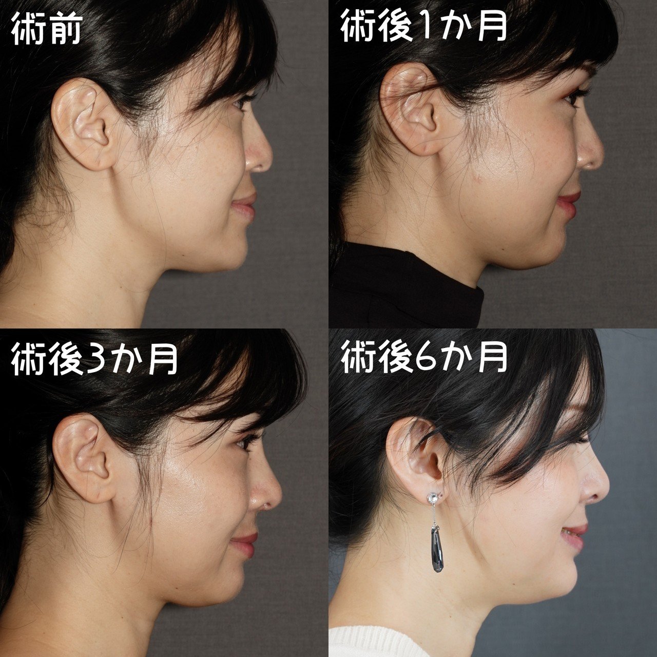 受け口感をなくす両顎手術 骨切りドクター宮崎 Note 受け口感をなくす両顎手術 骨切りドクター宮崎 Note