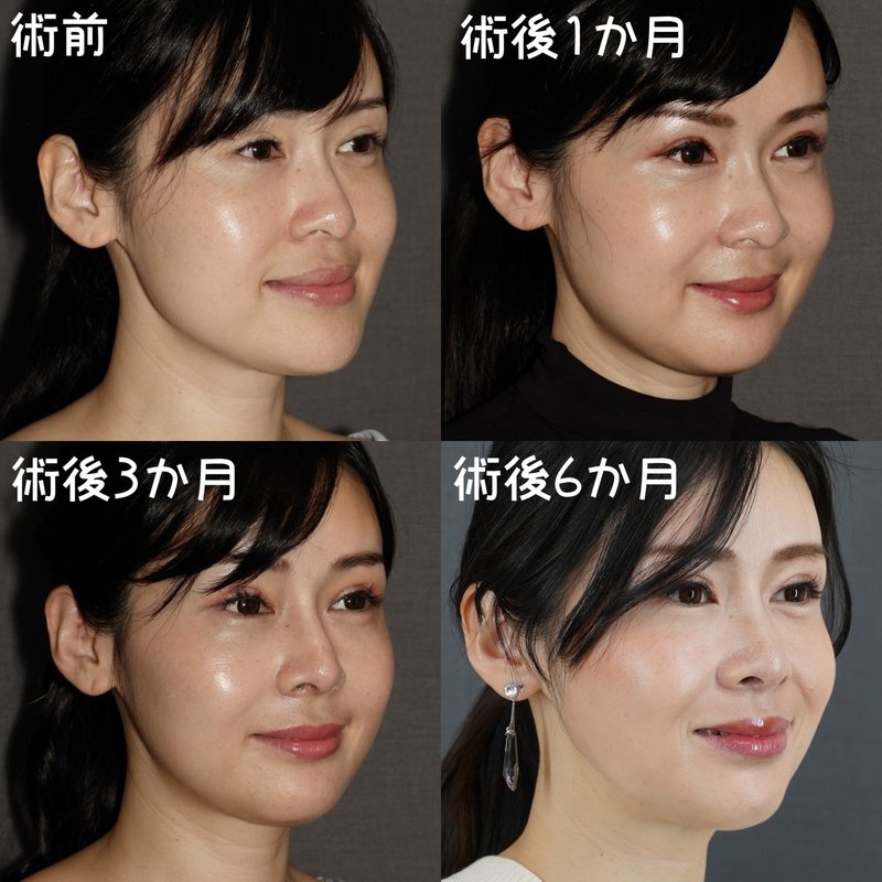 受け口感をなくす両顎手術 骨切りドクター宮崎 Note