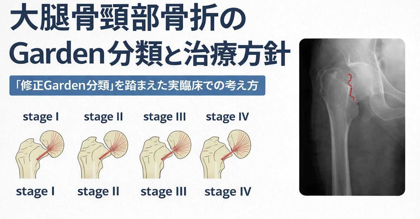 大腿骨頸部骨折のGarden分類と治療方針｜とっとこ画像診断太郎