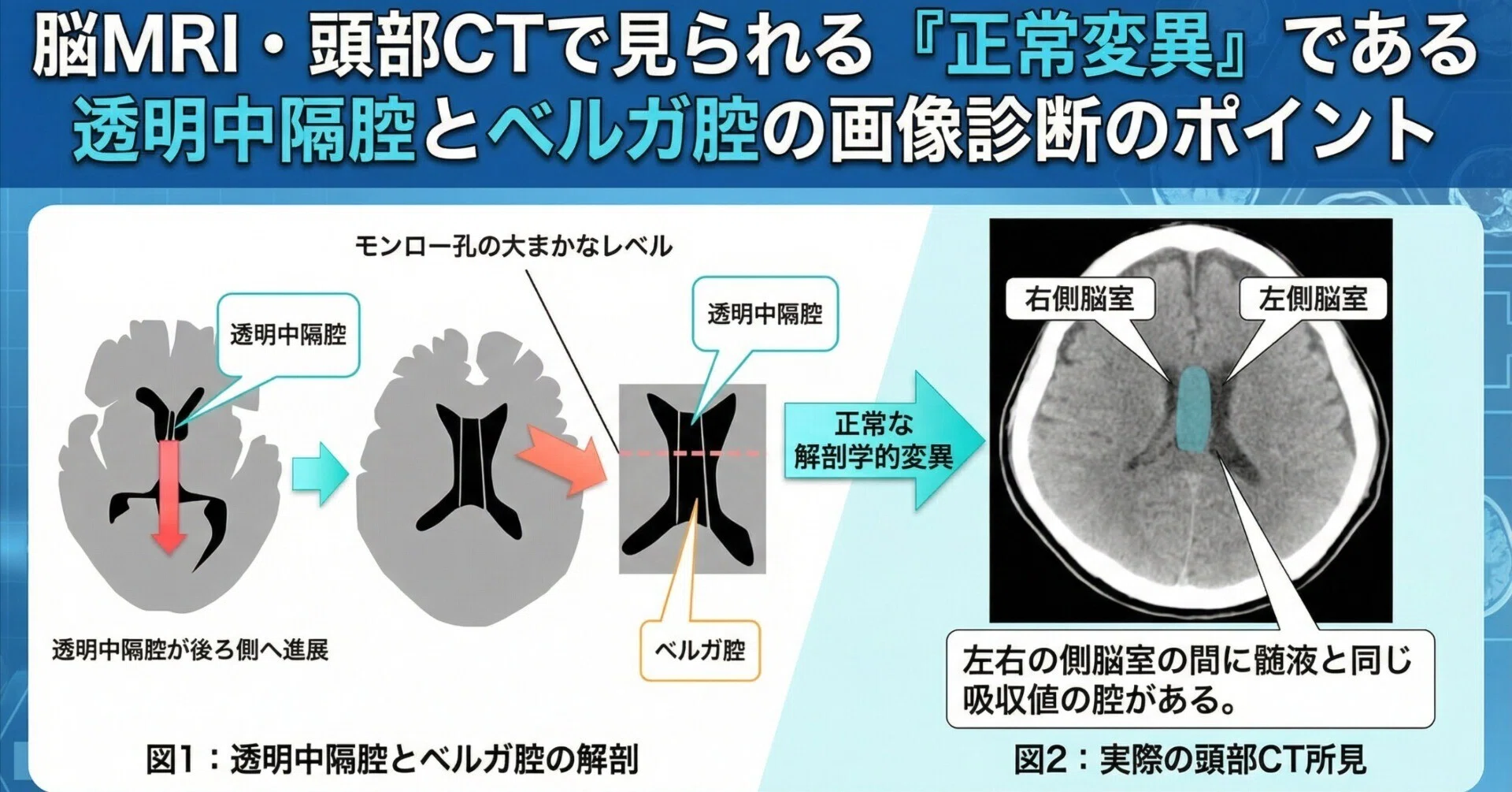 脳MRI・頭部CTで見られる「正常変異」である透明中隔腔とベルガ腔の