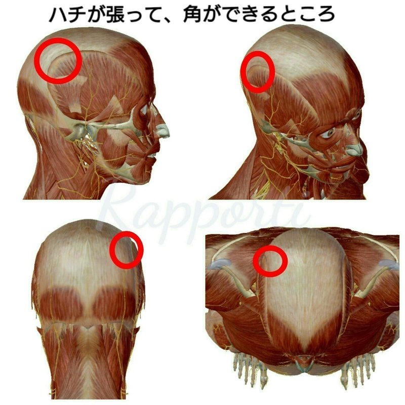 頭に角が生えたみたいに ハチ が張る その角をどうにかしたい しづ Note 頭に角が生えたみたいに ハチ が張る その角をどうにかしたい しづ Note