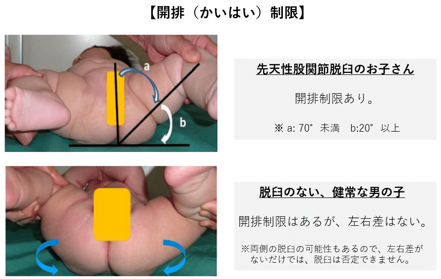 52 小児科医ママが解説 おうちで健診 Vol 5 股関節脱臼 おうちで見られるポイントはある シワに左右差があるけど脱臼 なの さよママ 小児科医 Note