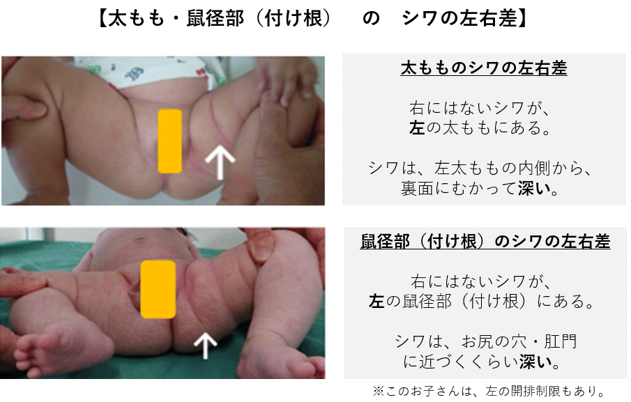 赤ちゃん　股間 