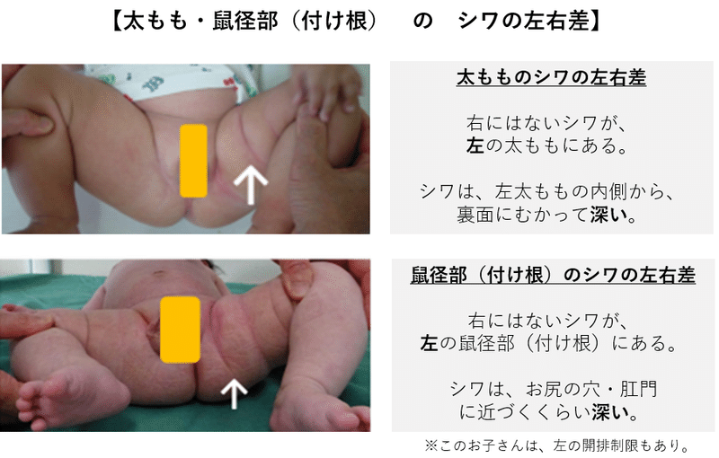 52 小児科医ママが解説 おうちで健診 Vol 5 股関節脱臼 おうちで見られるポイントはある シワ に左右差があるけど脱臼なの さよママ 小児科医 Note