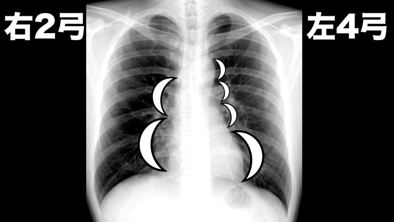 胸部X線写真.001