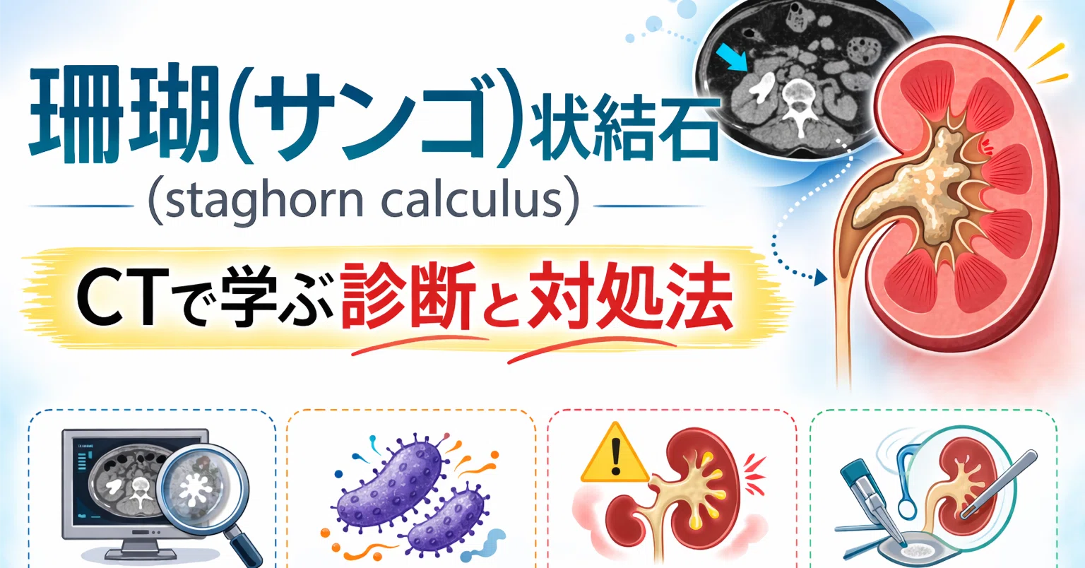 珊瑚（サンゴ）状結石（staghorn calculus）とは？CT画像診断の