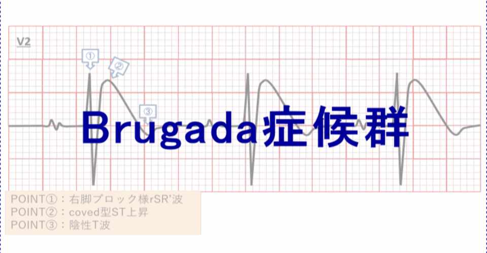 心電図イラスト Brugada症候群 Ceme Jpeg Note