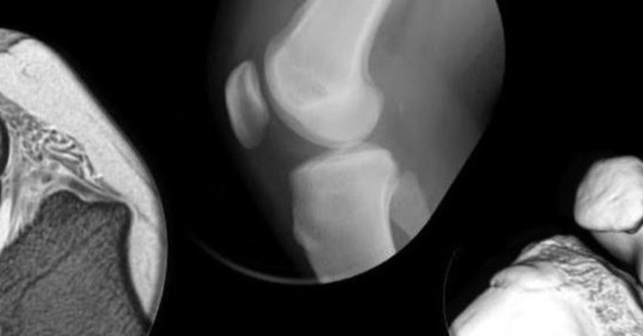 半月板嚢胞に伴う骨溶解の頻度と特徴は こぼうず 画像診断医 Note 半月板嚢胞に伴う骨溶解の頻度と特徴は こぼうず 画像診断医 Note