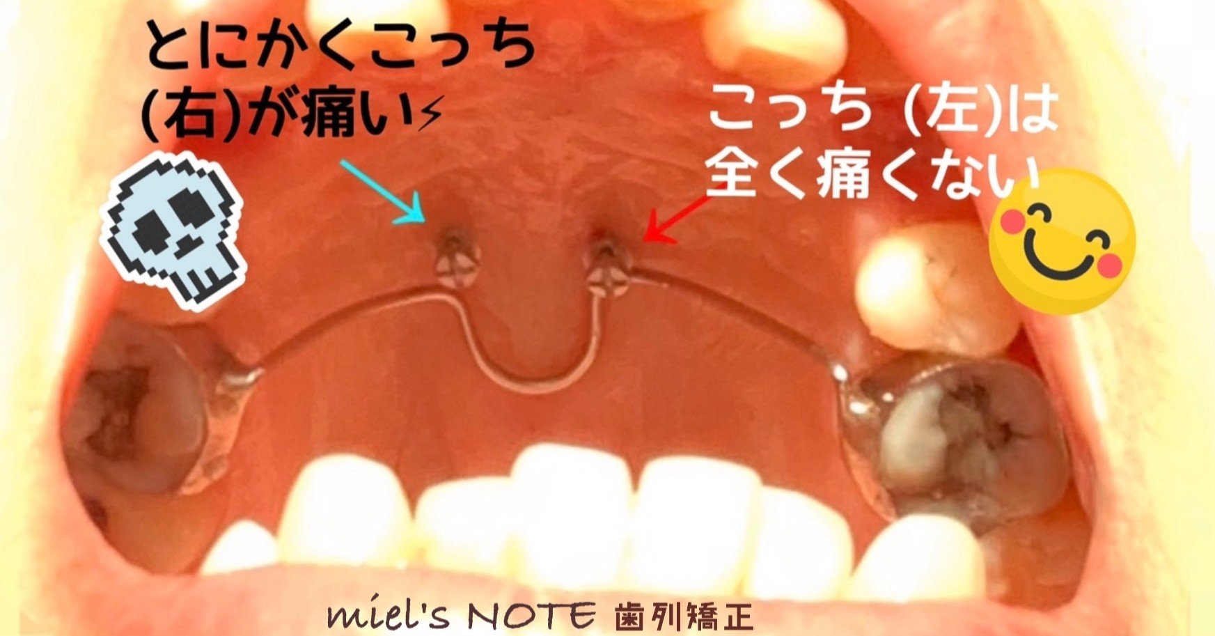 アンカースクリュー Miel Note アンカースクリュー Miel Note
