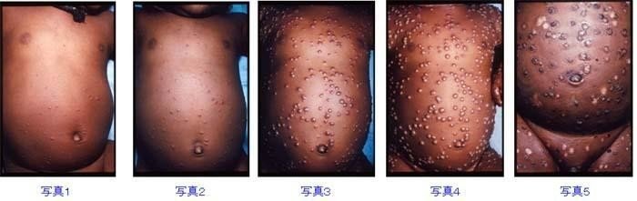 コロナと天然痘 グロい画像があるので 閲覧注意 Dr Abeko Note