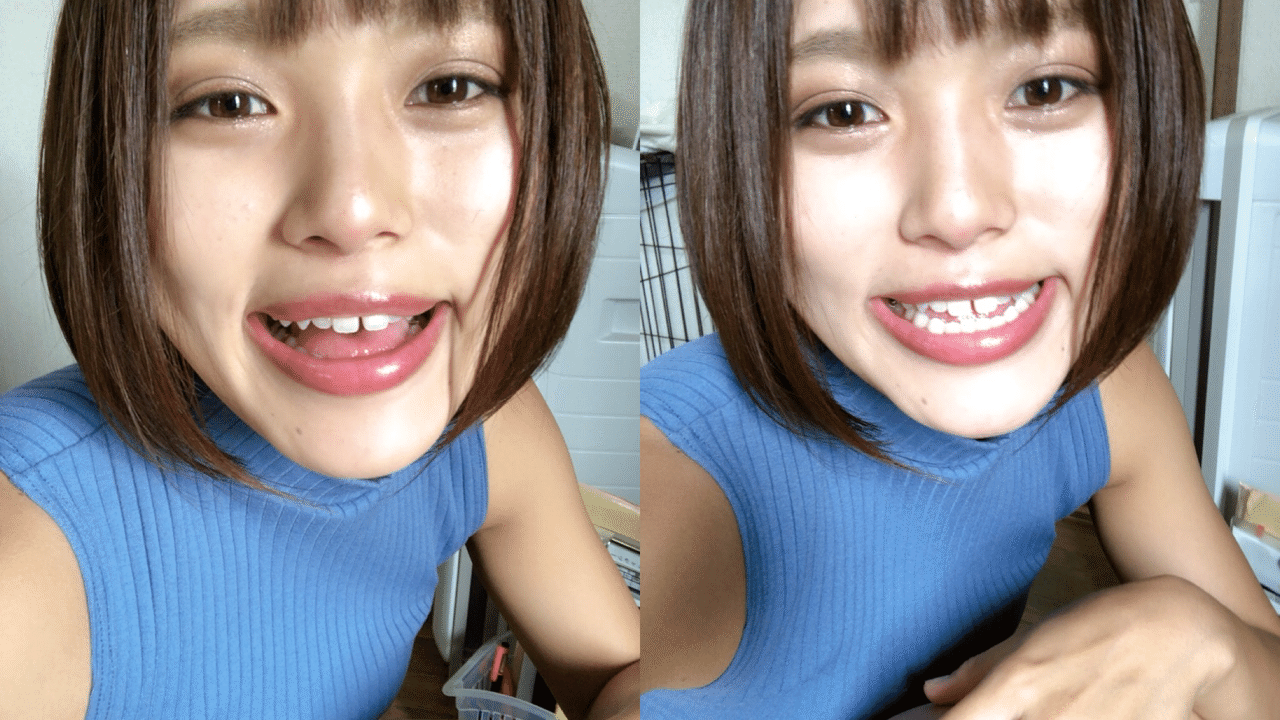 皆やるよね 受け口しゃくれの笑い方の工夫 26歳 顎変形症治療ブログ Note 皆やるよね 受け口しゃくれの笑い方の工夫 26歳 顎変形症治療ブログ Note