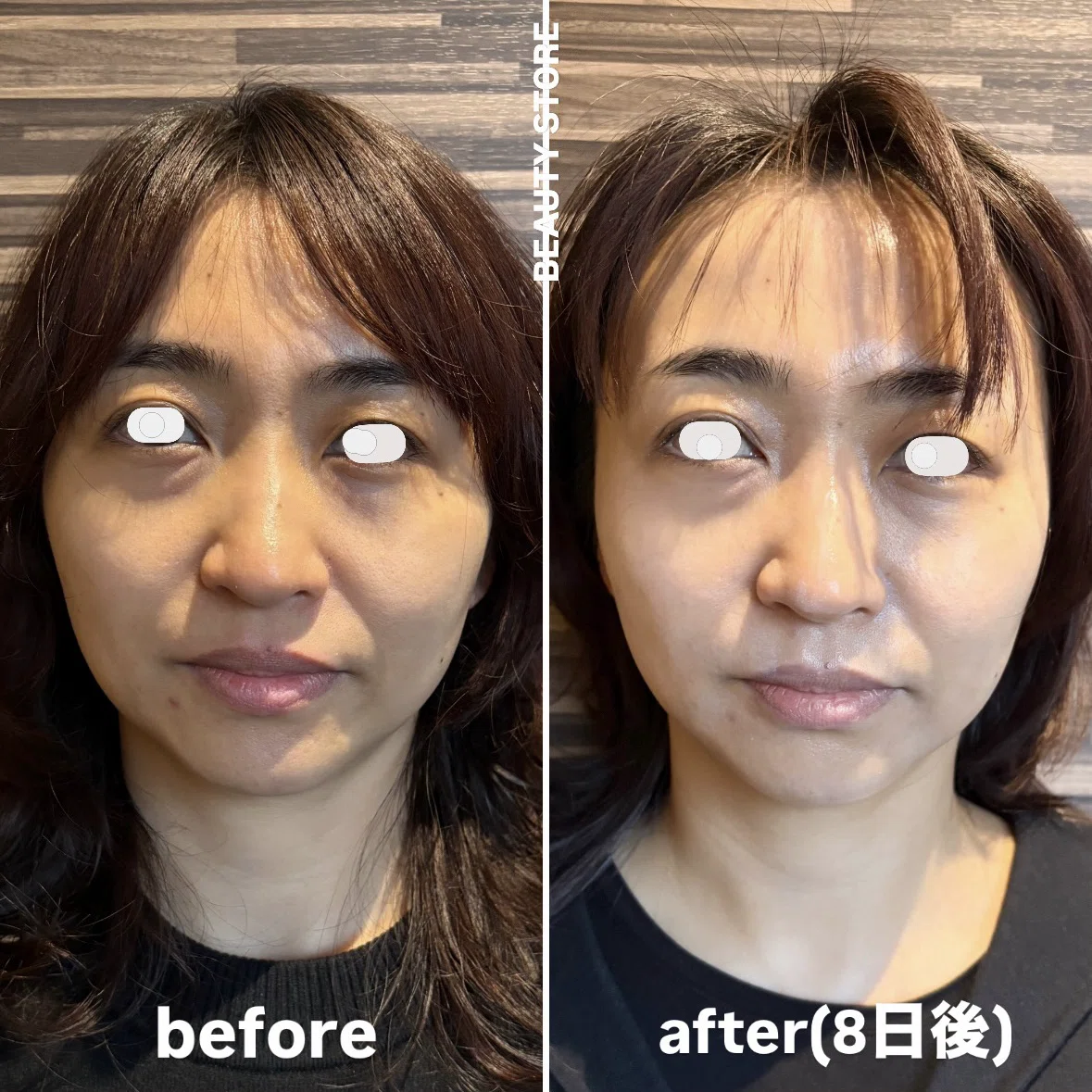 レモンボトル小顔造形before・after｜BEAUTY STOREサロンメニュー