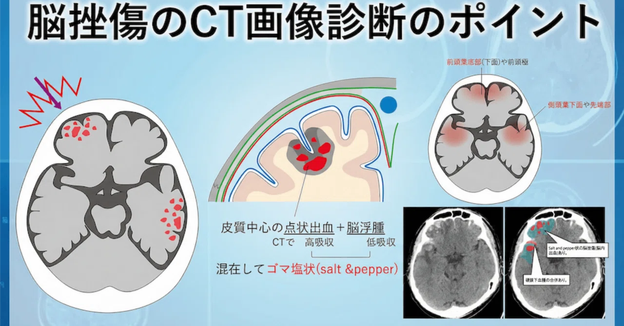 救急外来で頭部CTを読影する上で知っておきたい、脳挫傷のCT画像診断のポイント|とっとこ画像診断太郎