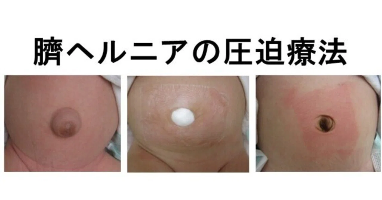 コラム78 ちょっと待って！そのでべその圧迫、大丈夫！？｜佐伯 勇