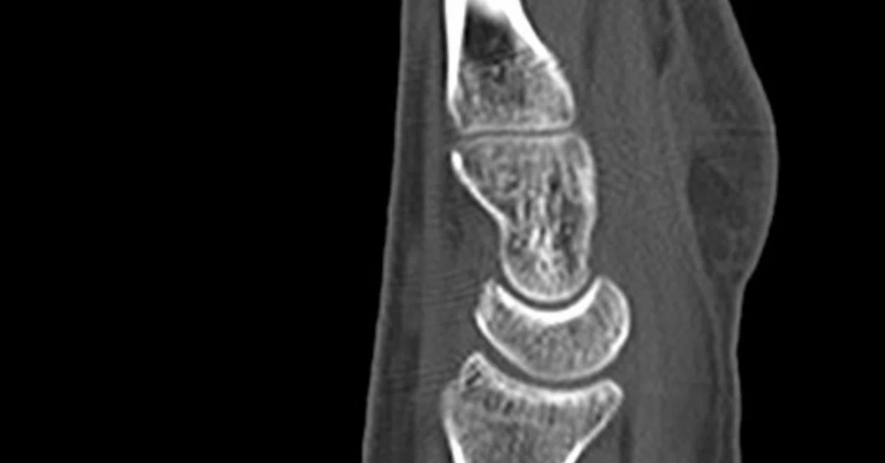 生まれて初めて骨を折る ⑤CTの診断結果、骨折の疑いなし|シギー