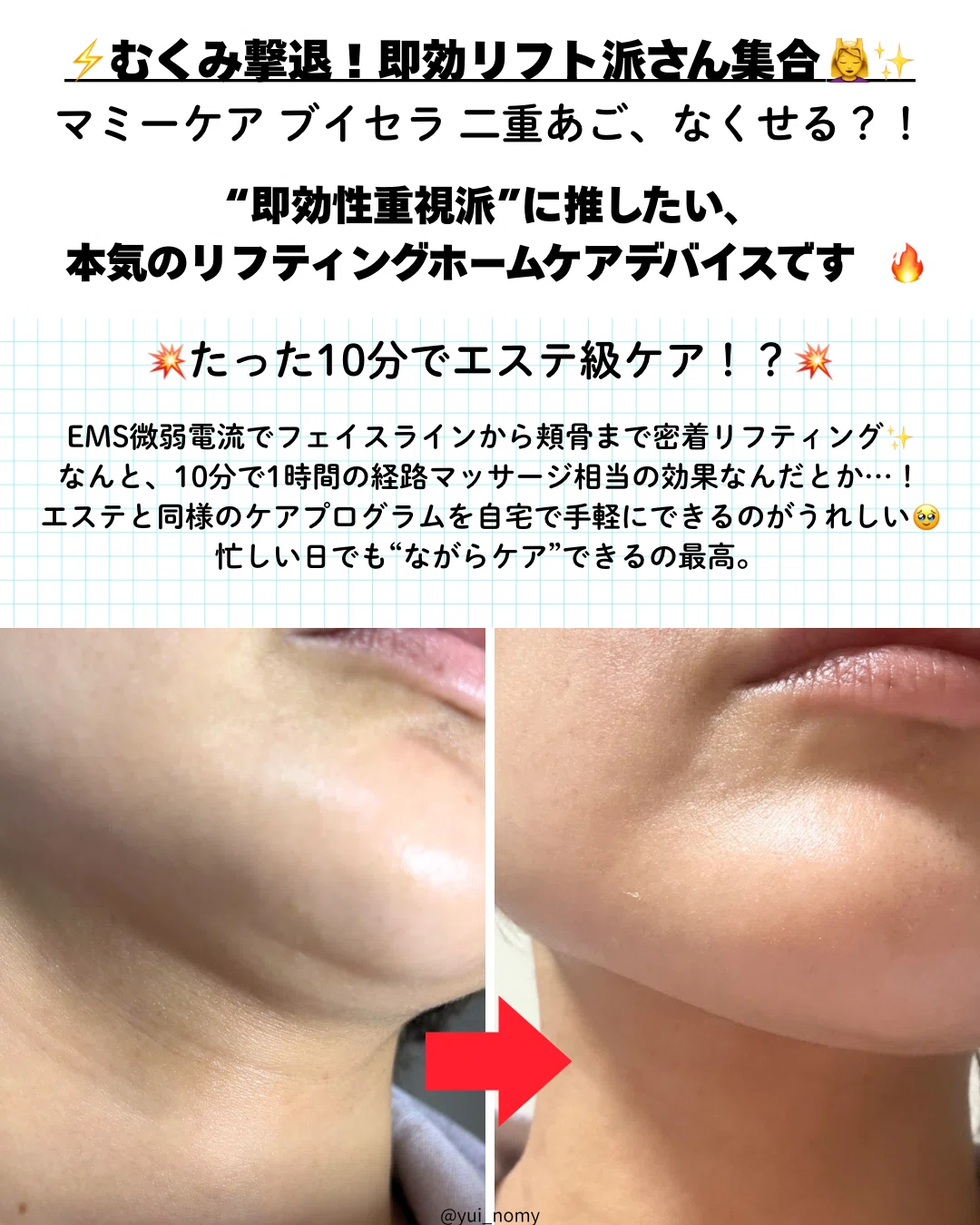 EMS ブイセラ Mommycare ブイセラ 美顔器 レビュー ミニオン｜yui_nomy