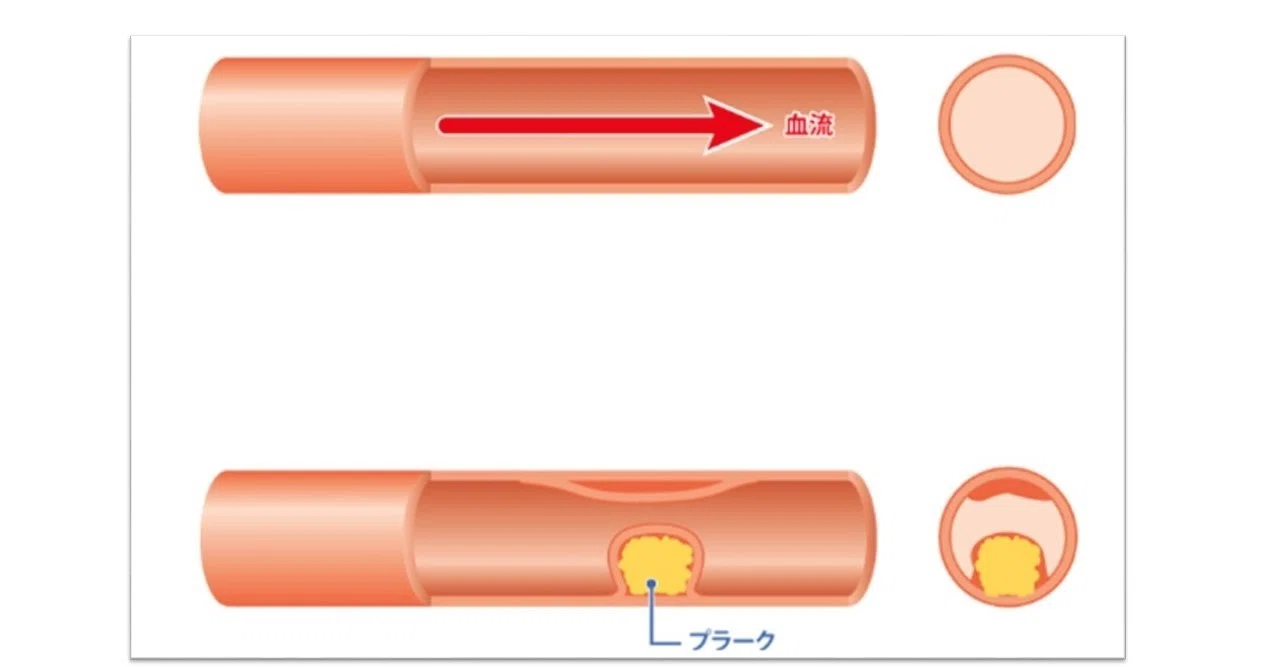 自分の足を守ろう~閉塞性動脈硬化症~|医療法人七ふく会 ふくいクリニック 七ふくハートクリニック